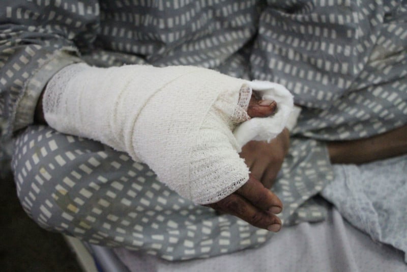 Bandaged hands of a person in a hospital gown